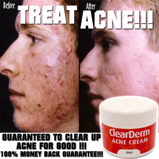 Clearderm Acne Cream Lotion High Strength Natural Ingredients Clear Skin!