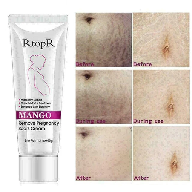 40 Ml Rtopr -Mango Entfernen Sie Schwangerschaftsnarben Creme Creme B9S7 D4H2