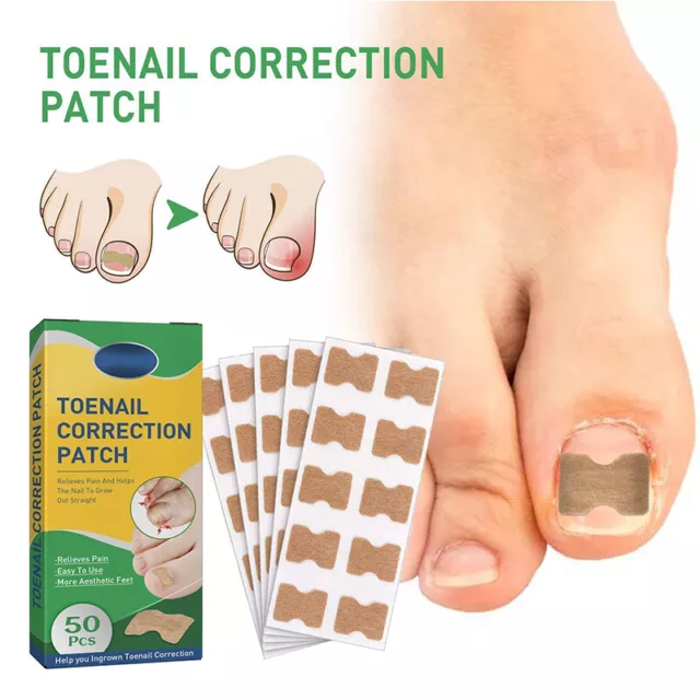 50Pcs Autocollants De Correction Des Ongles Patchs Correcteurs D'ongles *