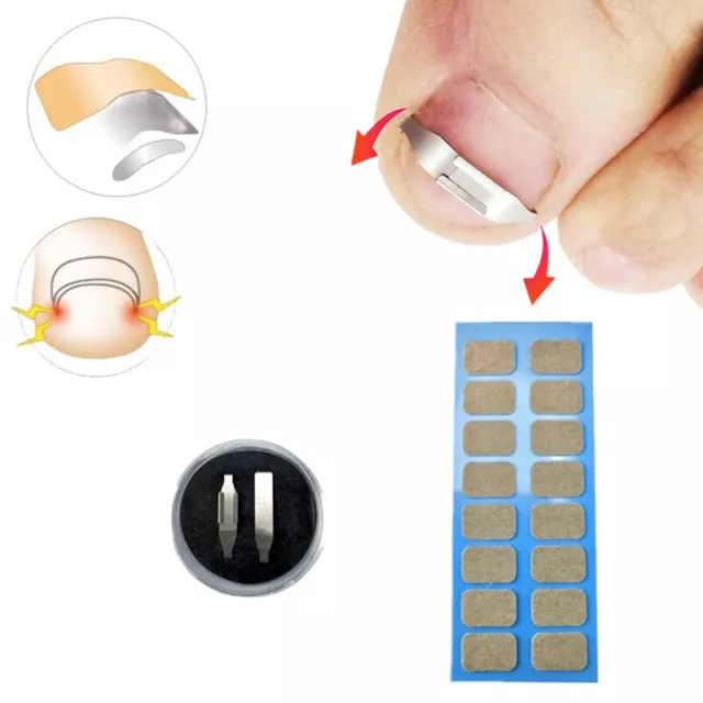 1set Ingrown Toe Nail Fixer Embed Toenail Correction Lifter Tool Pedicure