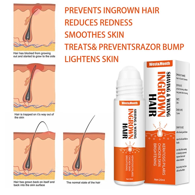 Suero para el cabello Deoroller Ingrowth cuidado de la piel tratamiento para el cabello Aftershave N ❤