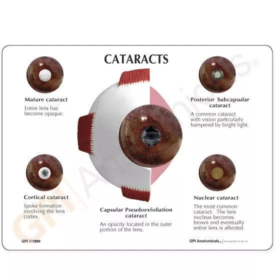 Eye Cataract GPI Anatomical Model Set of 5 LFA #2800 Make Us an Offer! See VIDEO 3