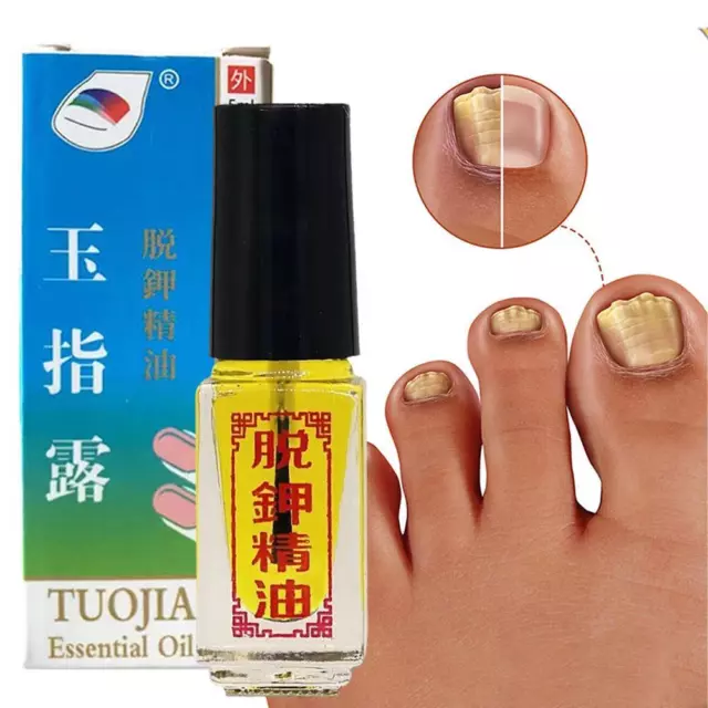 Traitement des ongles Fungus Anti fongique Toe Removal Care Infection Solution `