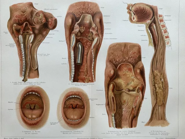 antike Grafik Medizin / Anatomie: Halskrankheiten Chromolithografie um 1900 2