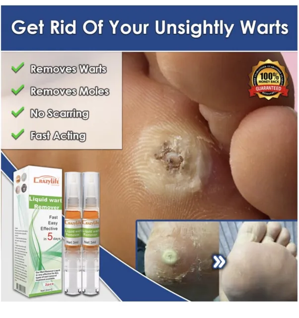New Fast Wart Remover Liquid Skin Tag Natural Treatment Moles Safe Verruca