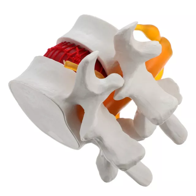 Lumbar Degenerative Model Spiral Bone Spine School+supplies