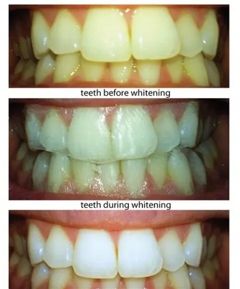 de bandes de blanchiment des dents Crest3D (10 sachets 20 bandes) 2