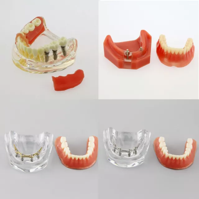 4 Type Dental Implants Restoration Overdenture Inferior Golden Study Demo Model