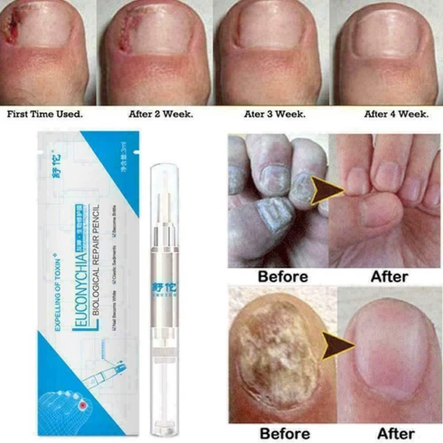 Fungal Nail Treatment Liquid Pen Nail Finger Toe Repair New Remov N9G5
