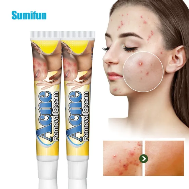 New 30g Acne Removal Cream Pimple Pits Pustule Deep Cleaning Face Repair Skin