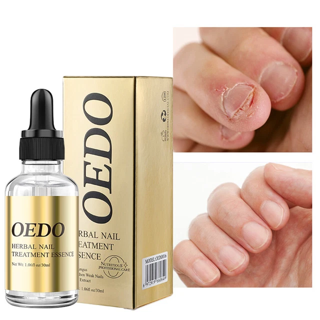 Anti Hongos Tratamiento de Uñas Pie Aceite Onychomycosis Removedor Mano Pulir <