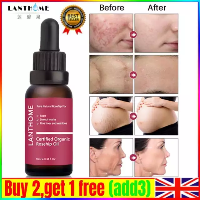 New Stretch Mark & Scar Remover Oil Fast Safe Natural Rosehip Heal Fade Marks