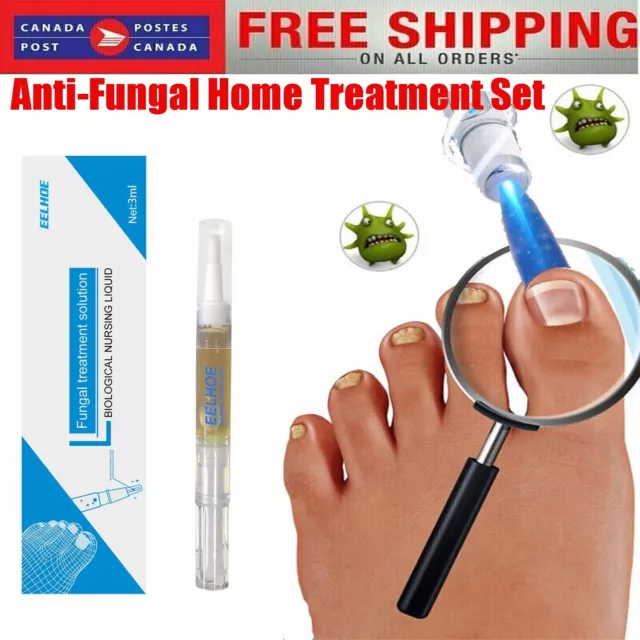 Anti fungal Home Treatment Set Laser Pen Finger Toe Nail Fungus Care Liquid Kit