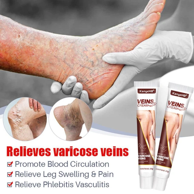 20G VARICOSE VEINS Vasculitis Legs Treatment Cream Phlebitis Itchy Gel