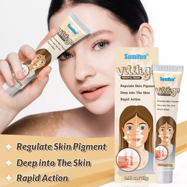 Regulate Skin Pigment Vitiligo Bald White Spot Treatment Vitiligo Removal Cream