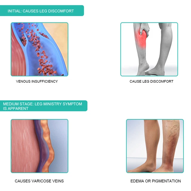 Medias de compresión médica venas varicosas medias adelgazamiento de piernas (M NUEVAS