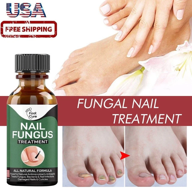 NAIL FUNGUS ANTIFUNGAL Home Treatment Toe and Finger Nail Infection