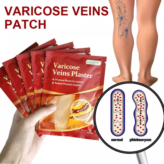 Plâtre Pour Varices 6 Pièces Vasculite Phlébite Jambe D'araignée Pat Médical R