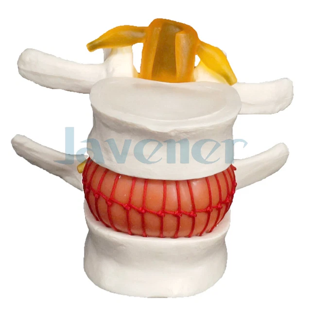 HUMAN LUMBAR MODEL Anatomical Disc Herniation Medical Learn Aid