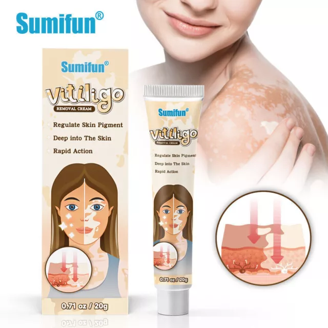 Regulate Skin Pigment Vitiligo Bald White Spot Treatment Vitiligo Removal Cream 2
