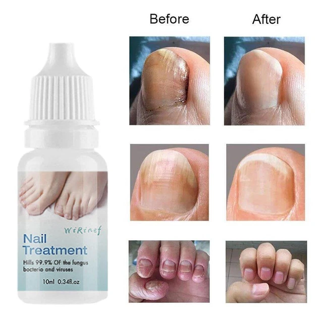 Trattamento Funghi Riparazione Essenza Punta Piede Rimozione Funghi Gel Anti Infezioni