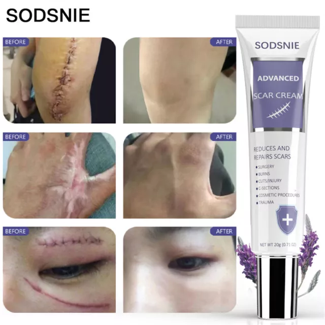 Best Scar removal Cream Reduce Surgery Acne Stretch Marks Skin Care for Scars