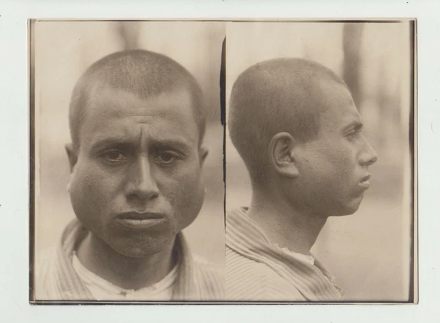 Vintage Medical Oddity Disease Accident Diformity Photo Freak Strange Circus 01
